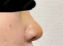 隆鼻術 / 鼻尖形成（切開） / 鼻中隔延長（切開） / 軟骨移植 / 鼻孔縁挙上 / 鼻翼基部形成（貴族手術） / 鼻柱下降・鼻唇角形成（猫手術） 4Dクリニック DAY 7 サムネイル用