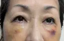 下まぶたの脂肪取り / 脂肪注入（目の下） 湘南美容クリニック 千葉センシティ院 DAY 5 サムネイル用