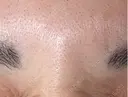ボトックス（眉間） Leap beauty clinic AFTER サムネイル用