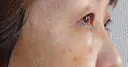 下まぶたの脂肪取り / 脂肪注入（目の下） 湘南美容クリニック 千葉センシティ院 DAY 6 サムネイル用