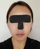 糸リフト / バッカルファット除去 / 脂肪吸引（顔） / ジョールファット除去 / ボトックス（エラ・小顔） アリエル美容クリニック 大宮院 DAY 60 サムネイル用