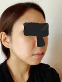 糸リフト / バッカルファット除去 / 脂肪吸引（顔） / ジョールファット除去 / ボトックス（エラ・小顔） アリエル美容クリニック 大宮院 DAY 60 サムネイル用