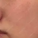ピーリング（ニキビ・毛穴） エルーラクリニック DAY 1 サムネイル用