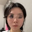 糸リフト / 脂肪吸引（顔） / ジョールファット除去 A CLINIC（エークリニック） 横浜院 DAY 0 サムネイル用