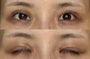 二重切開 / 眼瞼下垂（切開） / スレッドノーズ / ヒアルロン酸注入（鼻翼基部） オーキッド美容クリニック東京御徒町 DAY 162 サムネイル用
