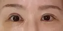 二重埋没 / 目頭切開 / 下まぶたの脂肪取り / タレ目形成・グラマラスライン（切開） 池袋麗歯科・美容皮膚科 DAY 9 サムネイル用