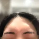 ボトックス（眉間） / ボトックス（額） MAクリニック 心斎橋 AFTER サムネイル用