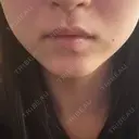 ハイフ（顔） 表参道メディカルクリニック 名古屋院 AFTER サムネイル用