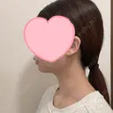 糸リフト / 脂肪吸引（顔） EMMA CLINIC（エマクリニック） DAY 32 サムネイル用