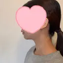 糸リフト / 脂肪吸引（顔） EMMA CLINIC（エマクリニック） DAY 90 サムネイル用