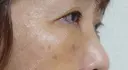下まぶたの脂肪取り / 脂肪注入（目の下） 湘南美容クリニック 千葉センシティ院 DAY 7 サムネイル用