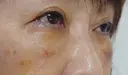 下まぶたの脂肪取り / 脂肪注入（目の下） 湘南美容クリニック 千葉センシティ院 DAY 7 サムネイル用