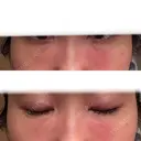 脂肪注入（目の下） 大塚美容形成外科 京都院 DAY 35 サムネイル用