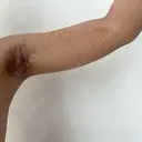 ワキ汗治療（切開） オーキッド美容クリニック東京御徒町 DAY 8 サムネイル用