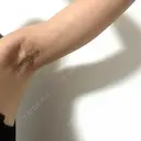 ワキ汗治療（切開） オーキッド美容クリニック東京御徒町 DAY 31 サムネイル用