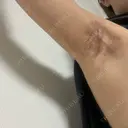 ワキ汗治療（切開） オーキッド美容クリニック東京御徒町 DAY 31 サムネイル用