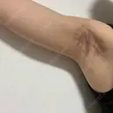 ワキ汗治療（切開） オーキッド美容クリニック東京御徒町 DAY 46 サムネイル用