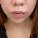 糸リフト / ヒアルロン酸注入（あご） / ボトックス（エラ・小顔） TCB東京中央美容外科 広島院 AFTER サムネイル用