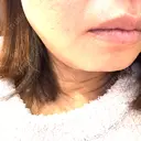 その他（輪郭） ルラ美容クリニック 大宮院 / ルラスキンクリニック 大宮院 DAY 1 サムネイル用