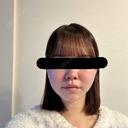 脂肪吸引（顔） / 脂肪吸引注射（顔） SEA CLINIC（シークリニック） DAY 125 サムネイル用