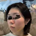 糸リフト / 脂肪吸引（顔） / ジョールファット除去 A CLINIC（エークリニック） 横浜院 DAY 5 サムネイル用