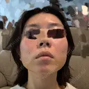 糸リフト / 脂肪吸引（顔） / ジョールファット除去 A CLINIC（エークリニック） 横浜院 DAY 5 サムネイル用