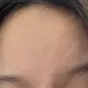ボトックス（あご） / ボトックス（眉間） / ボトックス（目尻） / ボトックス（額） TCB東京中央美容外科 名古屋栄院 AFTER サムネイル用