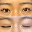 二重埋没 WOM CLINIC GINZA （ワム クリニック ギンザ） DAY 27 サムネイル用