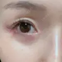 糸リフト / 目尻切開 / タレ目形成・グラマラスライン（切開） / ボトックス（あご） / ヒアルロン酸注入（あご） / ヒアルロン酸注入（鼻翼基部） Tokyo Tensei Clinic 新宿院 DAY 34 サムネイル用