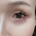 糸リフト / 目尻切開 / タレ目形成・グラマラスライン（切開） / ボトックス（あご） / ヒアルロン酸注入（あご） / ヒアルロン酸注入（鼻翼基部） Tokyo Tensei Clinic 新宿院 DAY 34 サムネイル用