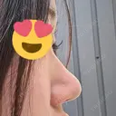 鼻尖形成（切開） / 軟骨移植 / 鼻尖縮小 / 鼻翼基部形成（貴族手術） / ヒアルロン酸注入（鼻翼基部） 東京シンデレラ美容外科 新宿院 DAY 110 サムネイル用