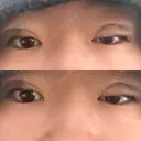 二重埋没 大塚美容形成外科 札幌院 DAY 0 サムネイル用