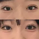 二重埋没 大塚美容形成外科 札幌院 AFTER サムネイル用