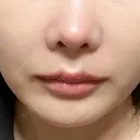 ボトックス（エラ・小顔） / ヒアルロン酸注入（唇） ルラ美容クリニック 名古屋栄院 / ルラスキンクリニック 名古屋栄院 DAY 31 サムネイル用