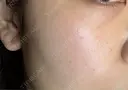 ルメッカ ルラ美容クリニック 渋谷本院 AFTER サムネイル用