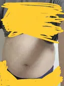 脂肪冷却（二の腕） / 脂肪冷却（お尻） DMTC CLINIC 渋谷院 DAY 0 サムネイル用