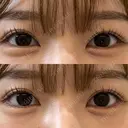 ヒアルロン酸注入（涙袋） / ボトックス（あご） / ヒアルロン酸注入（あご） / ボトックス（エラ・小顔） / ボトックス（口角） フィラークリニック 大阪心斎橋院 DAY 4 サムネイル用