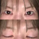 二重切開 / 目頭切開 / 上まぶたたるみ取り 湘南美容クリニック 大阪京橋院 DAY 506 サムネイル用