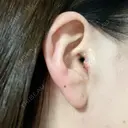 鼻尖形成（切開） / 小鼻縮小（切開） / 軟骨移植 / 鼻柱下降・鼻唇角形成（猫手術） / その他（鼻） 東京シンデレラ美容外科 池袋院 DAY 2 サムネイル用