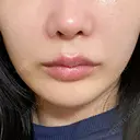 ボトックス（エラ・小顔） / ヒアルロン酸注入（唇） ルラ美容クリニック 名古屋栄院 / ルラスキンクリニック 名古屋栄院 DAY 32 サムネイル用