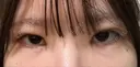 二重埋没 / 目頭切開 / 上まぶたの脂肪取り 9BeautyClinic DAY 21 サムネイル用