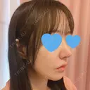 鼻尖形成（切開） / 小鼻縮小（切開） / ワシ鼻修正・ハンプ切除 / 鼻柱下降・鼻唇角形成（猫手術） ASTRA BEAUTY CLINIC DAY 104 サムネイル用
