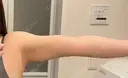 脂肪吸引（顔） / 脂肪吸引（二の腕） / 脂肪吸引（腰） / 脂肪吸引（背中） / 脂肪吸引（肩） Mods Clinic（モッズクリニック） 東京院 AFTER サムネイル用