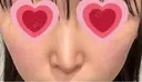 鼻尖形成（切開） / 小鼻縮小（切開） / 軟骨移植 / 鼻修正 / 鼻柱下降・鼻唇角形成（猫手術） R Beauty CLINIC 大阪院 DAY 175 サムネイル用