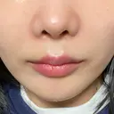ボトックス（エラ・小顔） / ヒアルロン酸注入（唇） ルラ美容クリニック 名古屋栄院 / ルラスキンクリニック 名古屋栄院 DAY 33 サムネイル用