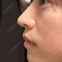 軟骨移植 / 目元修正 / 自然癒着法 / 鼻尖形成（非切開） eクリニック 福岡院 DAY 14 サムネイル用