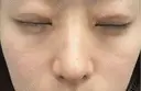 軟骨移植 / 目元修正 / 自然癒着法 / 鼻尖形成（非切開） eクリニック 福岡院 DAY 21 サムネイル用