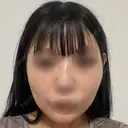 ボトックス（あご） M'sクリニック【エムズクリニック】 AFTER サムネイル用