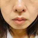 その他（輪郭） ルラ美容クリニック 大宮院 / ルラスキンクリニック 大宮院 AFTER サムネイル用