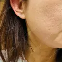 その他（輪郭） ルラ美容クリニック 大宮院 / ルラスキンクリニック 大宮院 DAY 4 サムネイル用